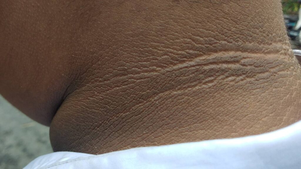 गर्दन पर काले निशान