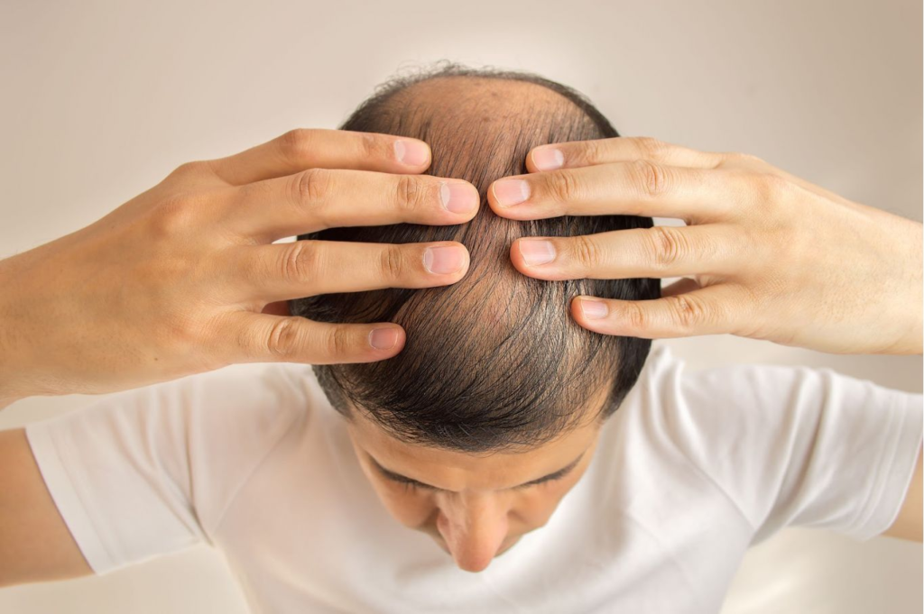 Hair Loss Prevention