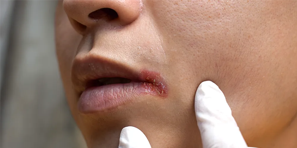 मुंह के कैंसर (Oral Cancer) 